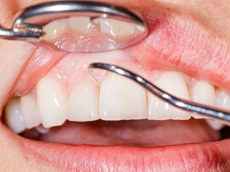 Non surgical gum treatment procedures
